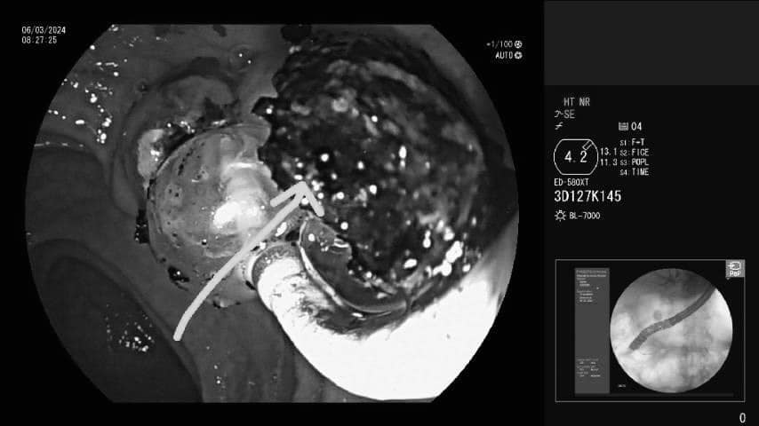 Gallstone Ignored for Months Leads to Serious Infection