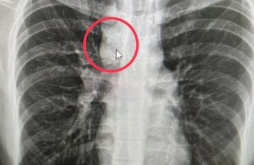 Young Man Diagnosed with Tuberculosis of Lymph Nodes After Mass Found in Bronchus Cover