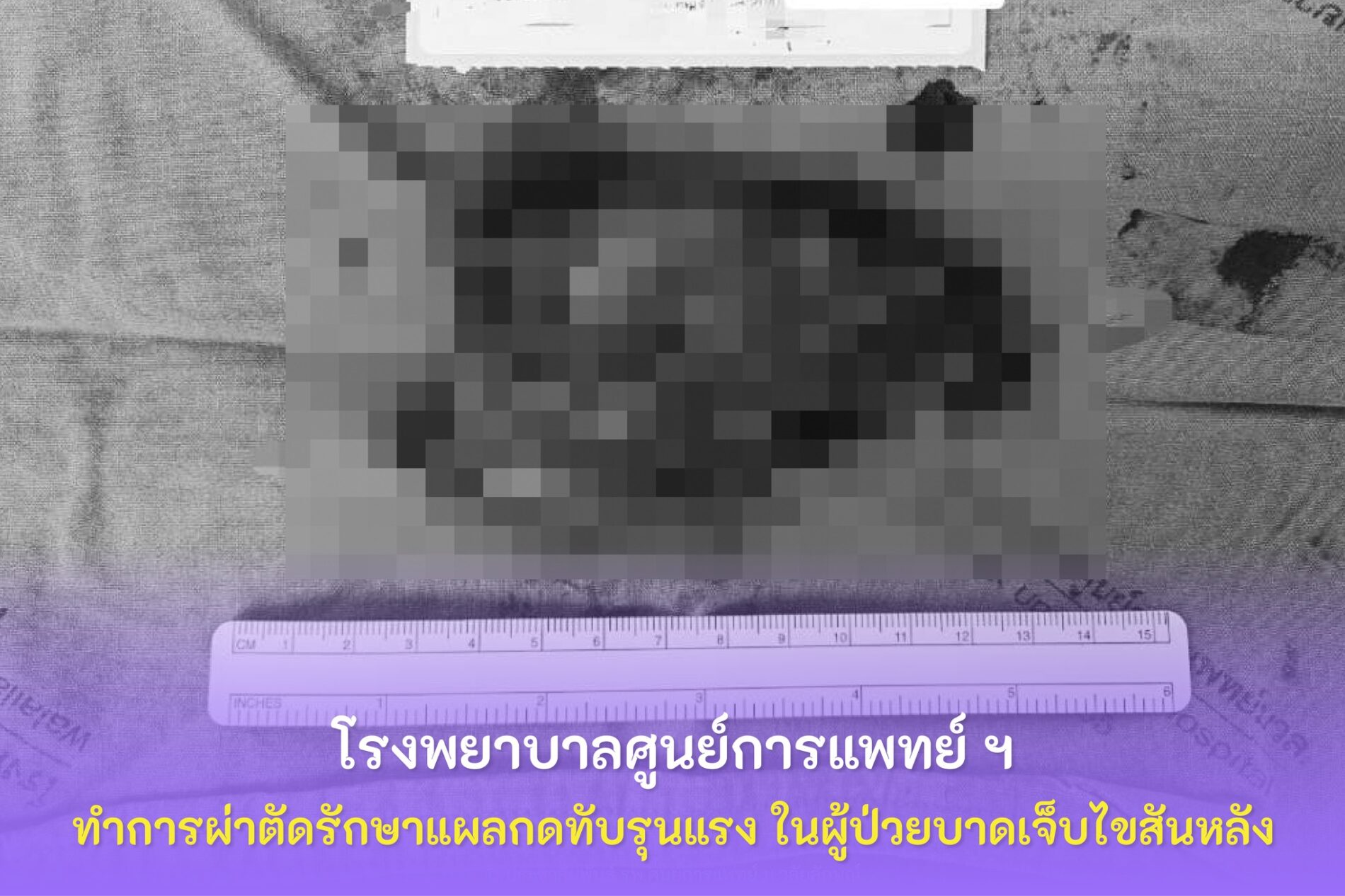 การผ่าตัดรักษาแผลกดทับรุนแรง ในผู้ป่วยบาดเจ็บไขสันหลัง