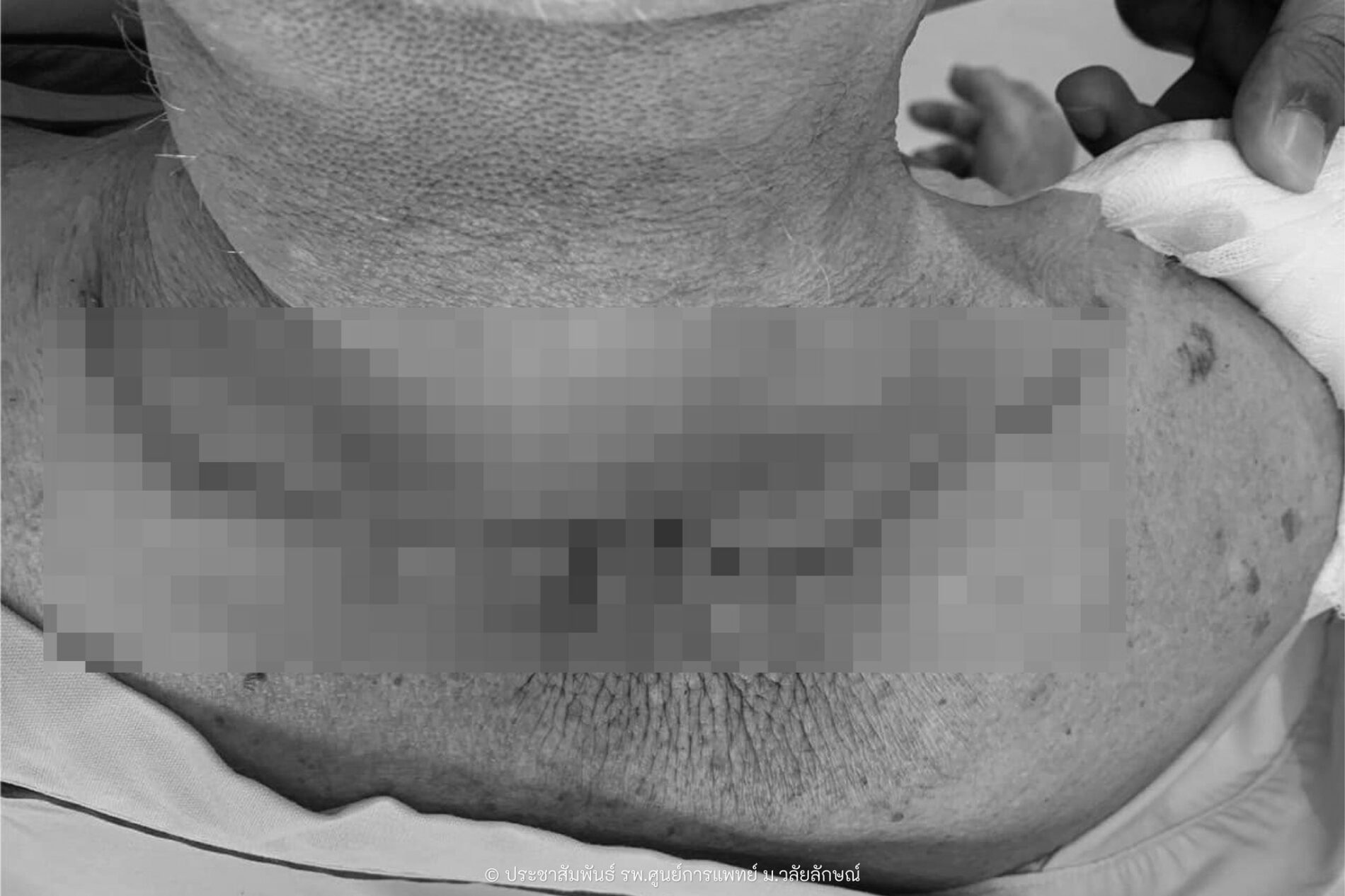 Walailak University Hospital Successfully Removes Massive Tumor from 87-Year-Old Patient